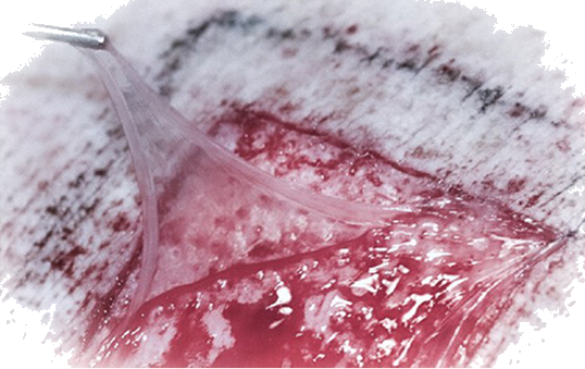Amnio AMP amniotic allograft