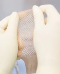 Emerge Matrix amniotic allograft